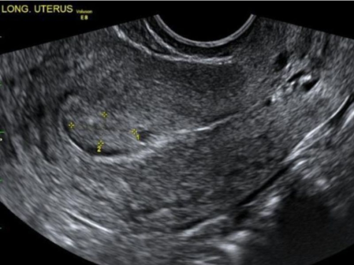 Endometrial polyp (Home) - Private Gynaecology